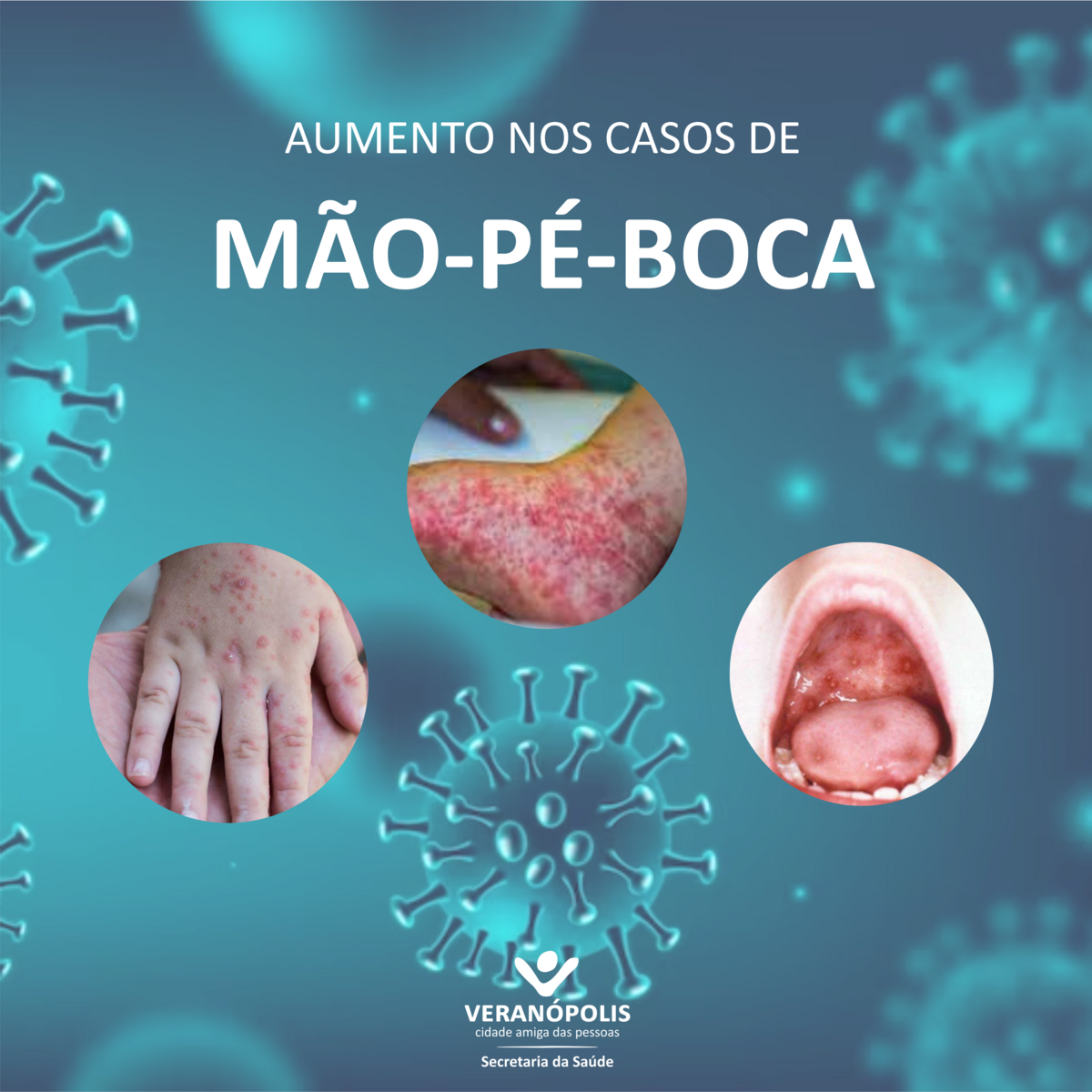 aumento-nos-casos-de-mao-pe-boca