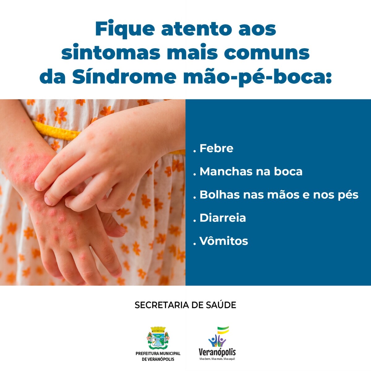 fique-atento-aos-sintomas-mais-comuns-da-sindrome-mao-pe-boca